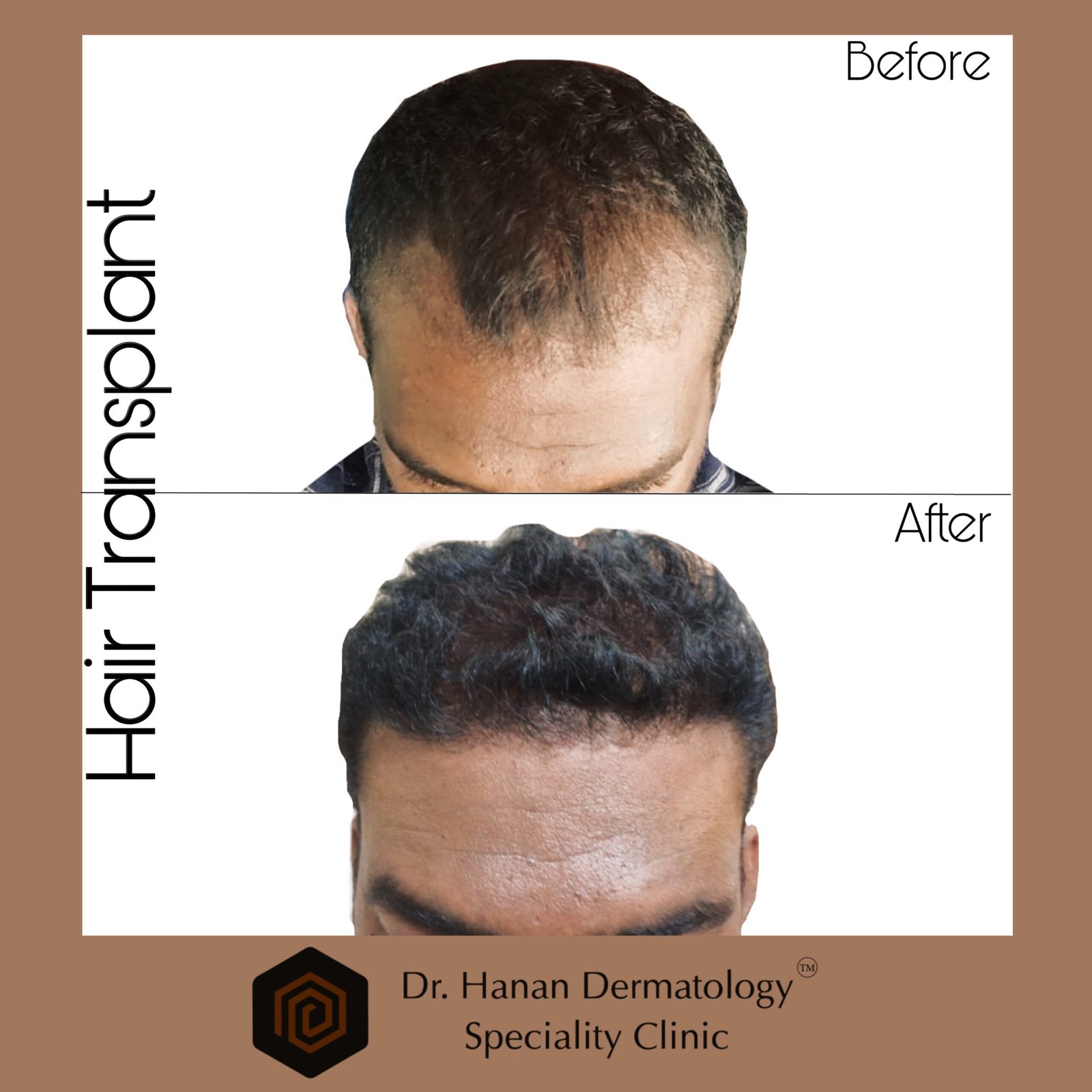 Best Hair Transplant Center in Chennai 2024