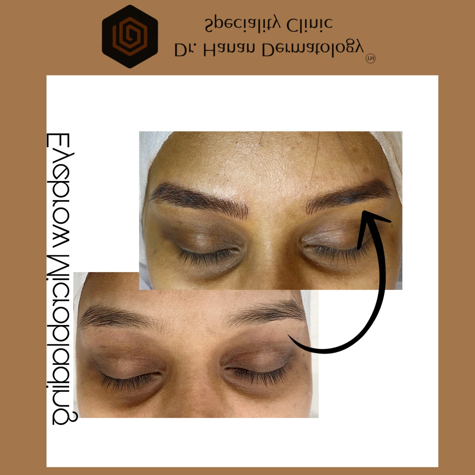 best eyebrow treatment in chennai