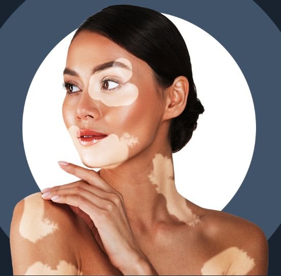 Vitiligo Treatment in Chennai