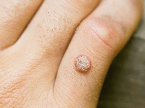 wart removal treatment