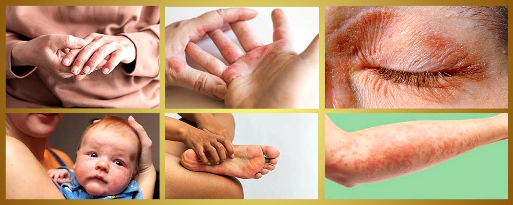 Eczema treatment in chennai