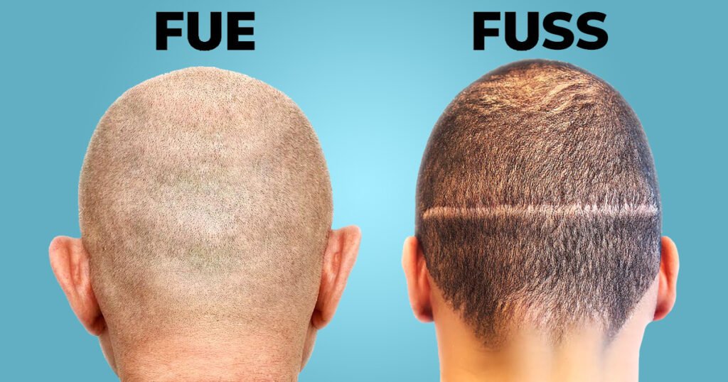 how much hair transplant cost in india