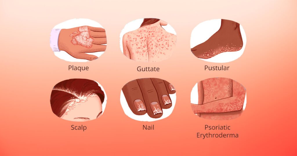 Types of Psoriasis