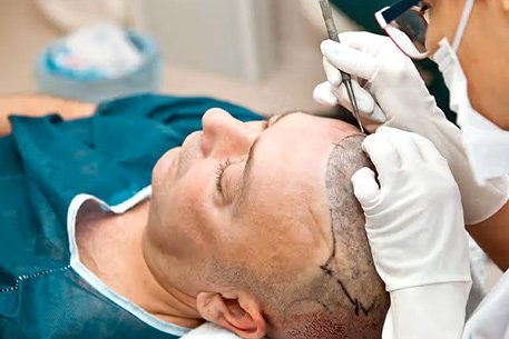 Best Hair Transplant Center in Chennai 2024