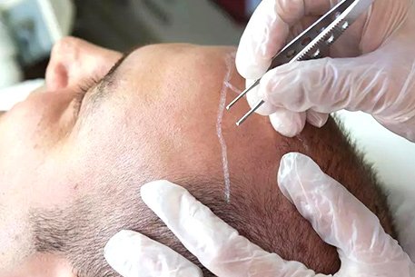 Best Hair Transplant Center in Chennai 2024