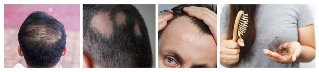 Hair Transplant Symptoms