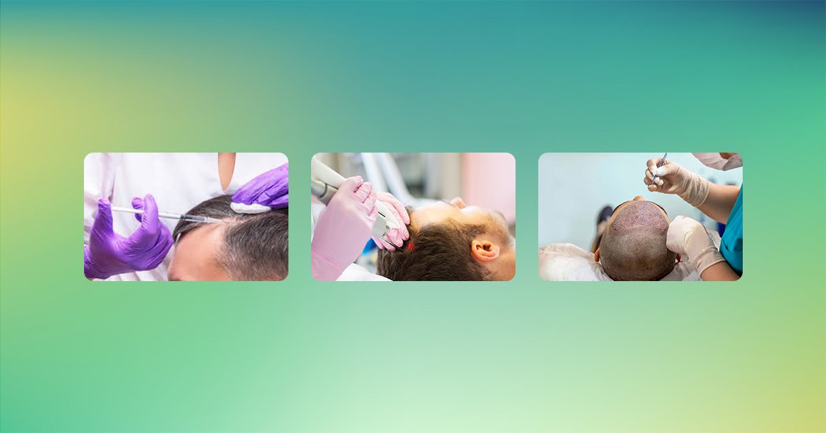  Medical Treatments for Persistent Bald Spots