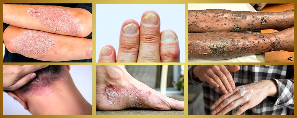 psoriasis