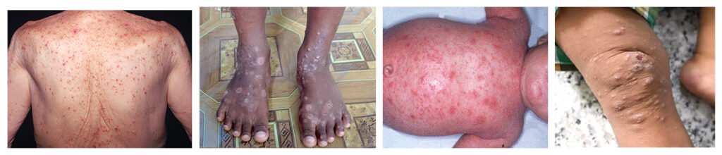 scabies symptoms