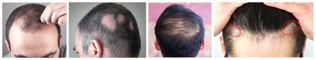 types of male baldness