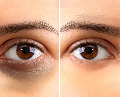 How to Remove Dark Circles Under Eyes