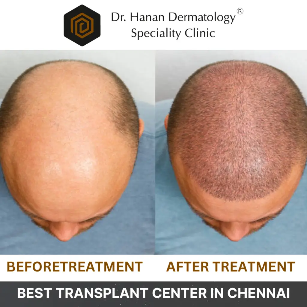 Best Hair Transplant Center in Chennai 2024