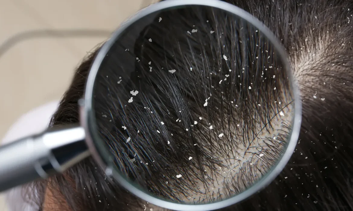 Best Homeopathic Medicine for Dandruff and Hair Fall Natural Remedies for Healthier Hair