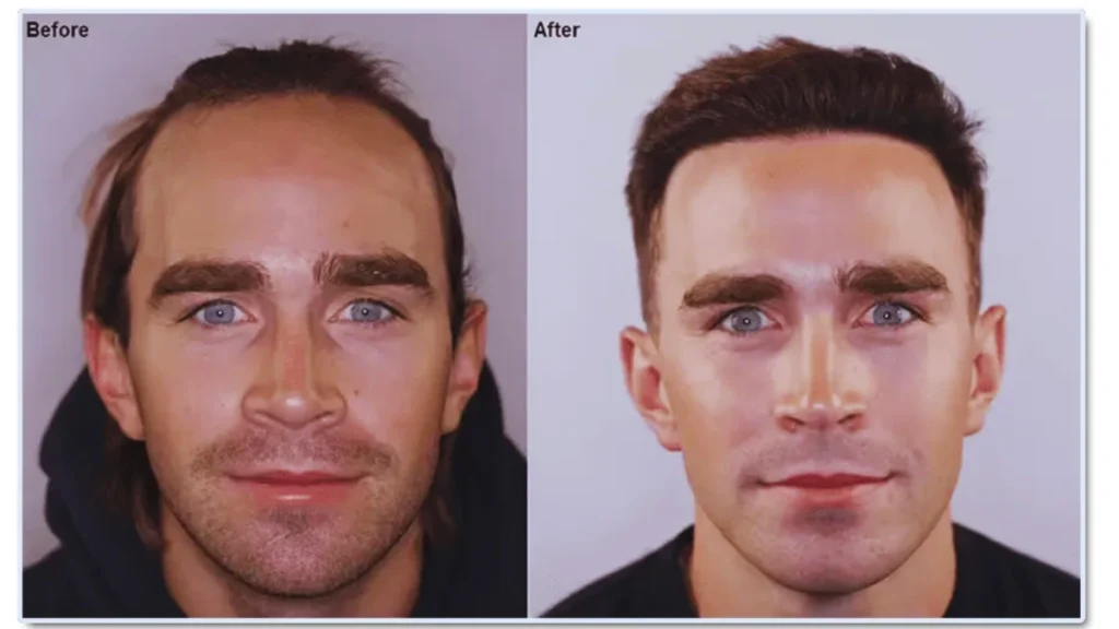 Best and Cheap Hair Transplant in Chennai Affordable Solutions for Hair Restoration