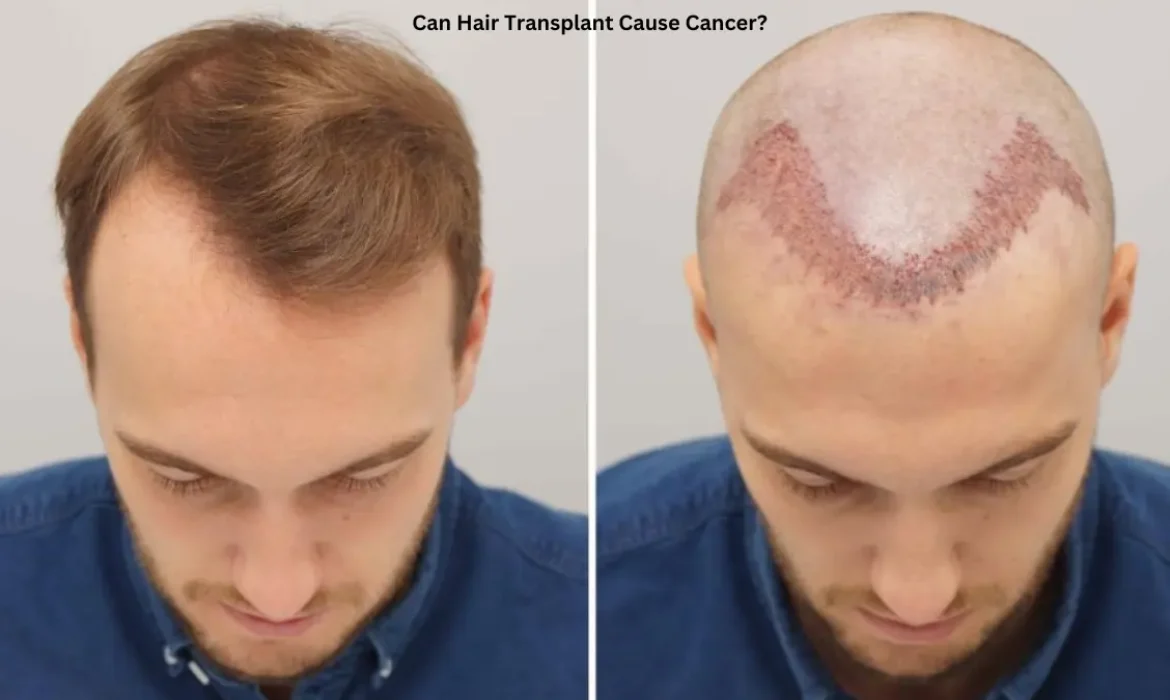 Can Hair Transplant Cause Cancer