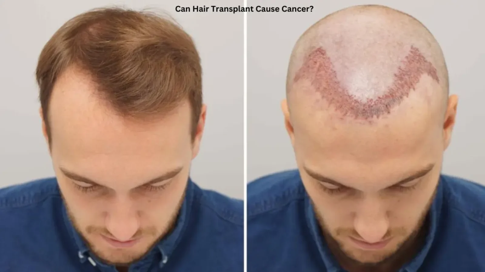 Can Hair Transplant Cause Cancer