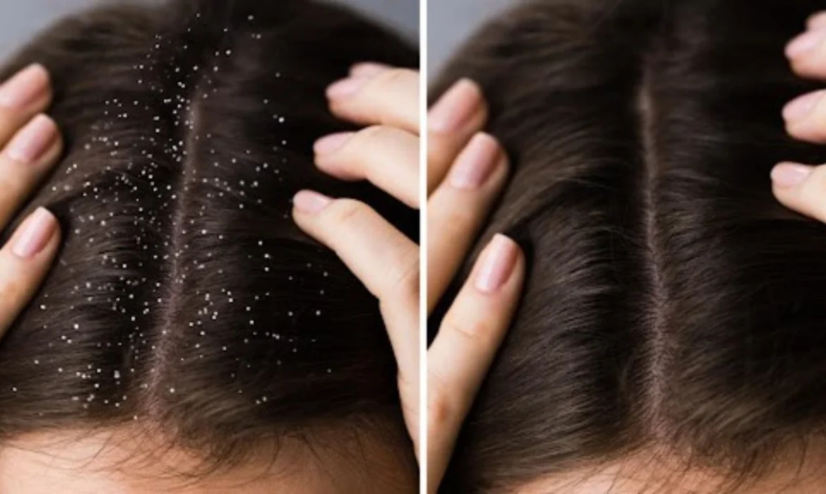 Dandruff Treatment A Complete Guide to a Healthier Scalp