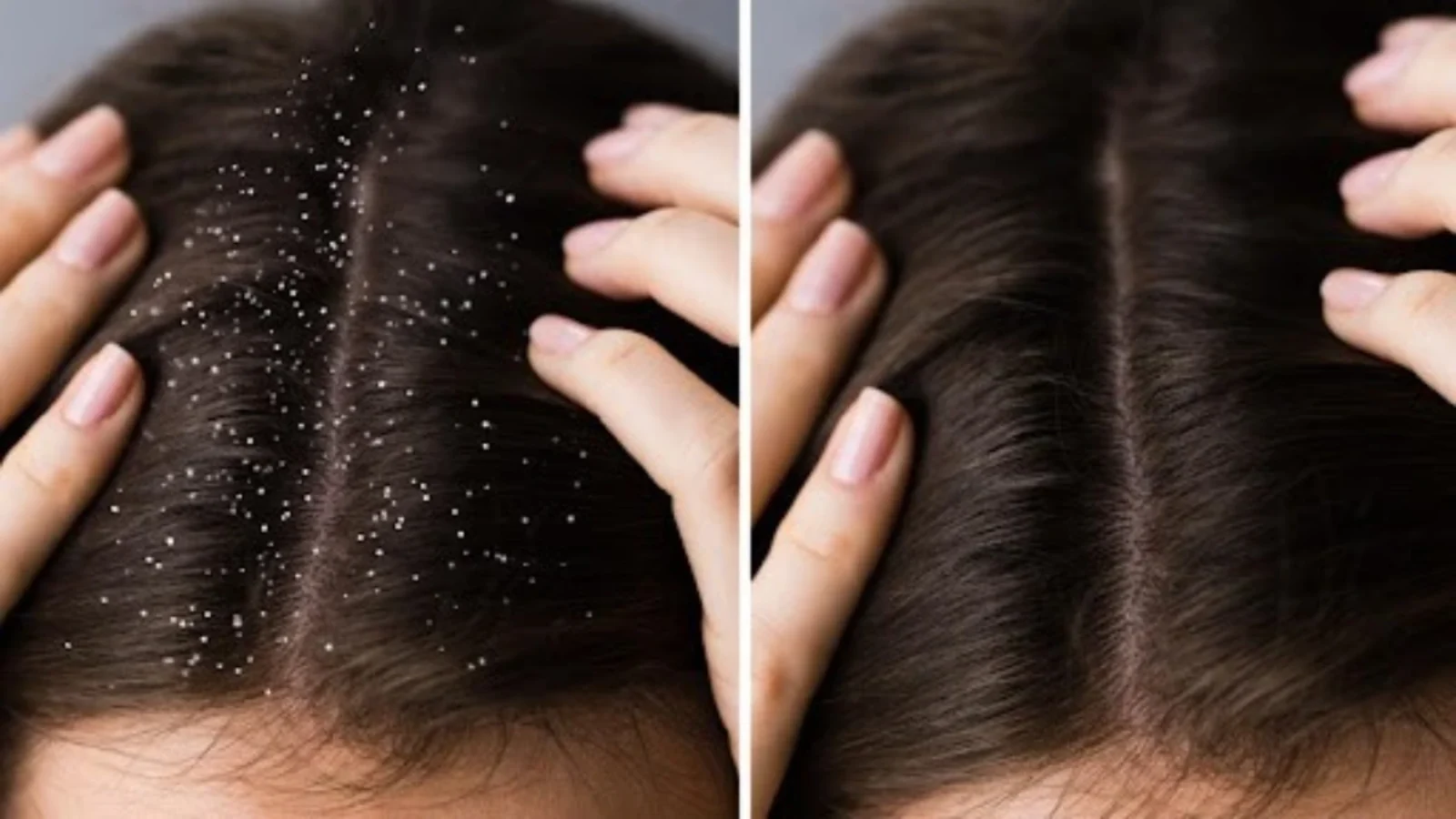 Dandruff Treatment A Complete Guide to a Healthier Scalp