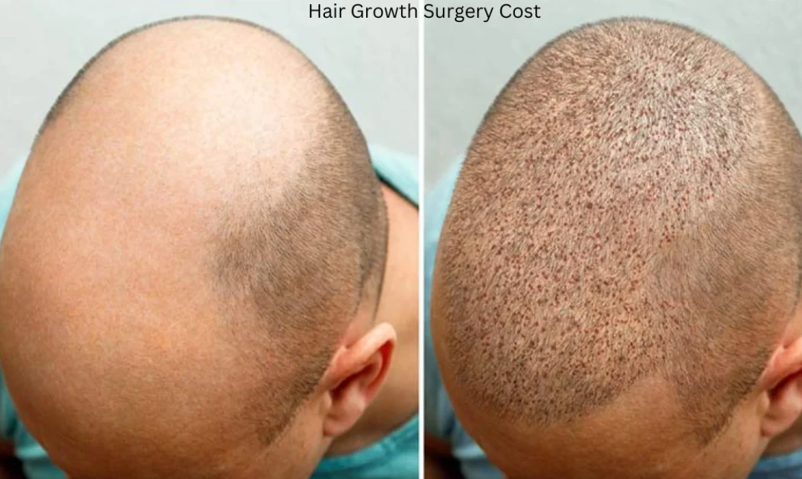 Hair Growth Surgery Cost