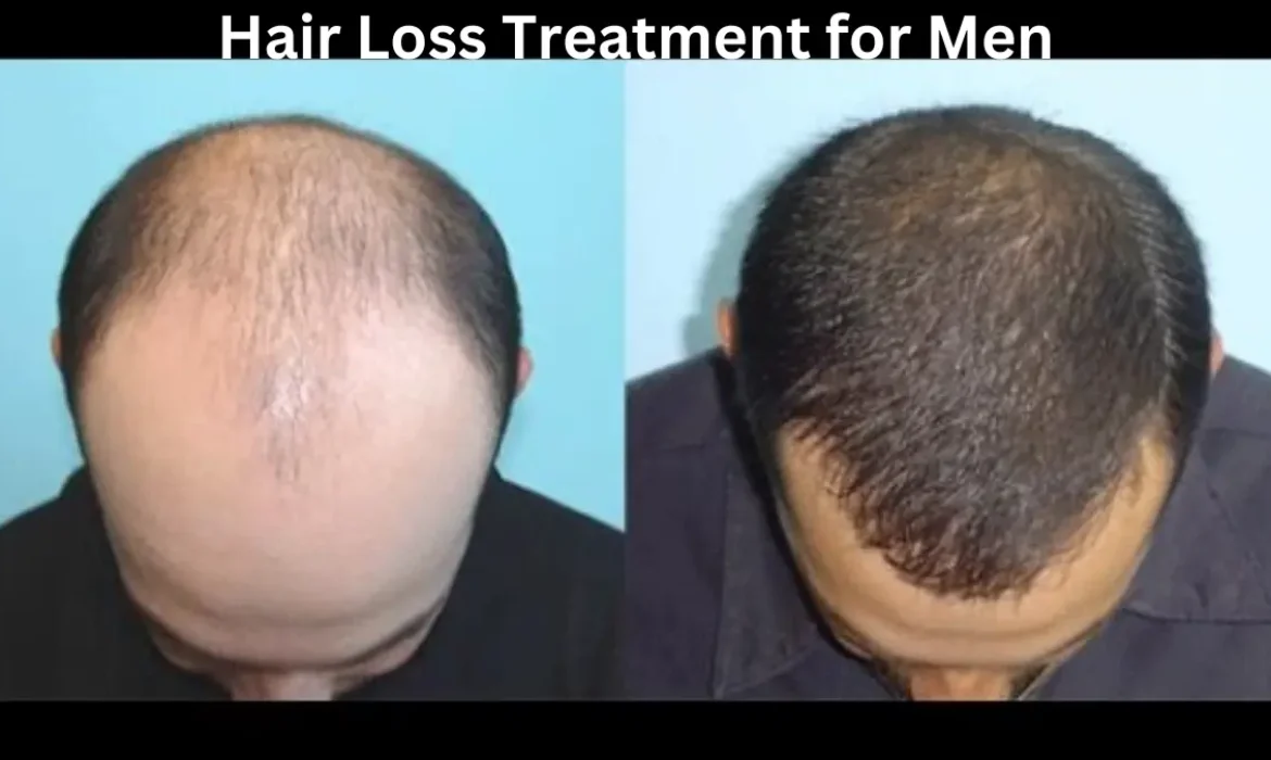 Hair Loss Treatment for Men Effective Solutions for Hair Regrowth