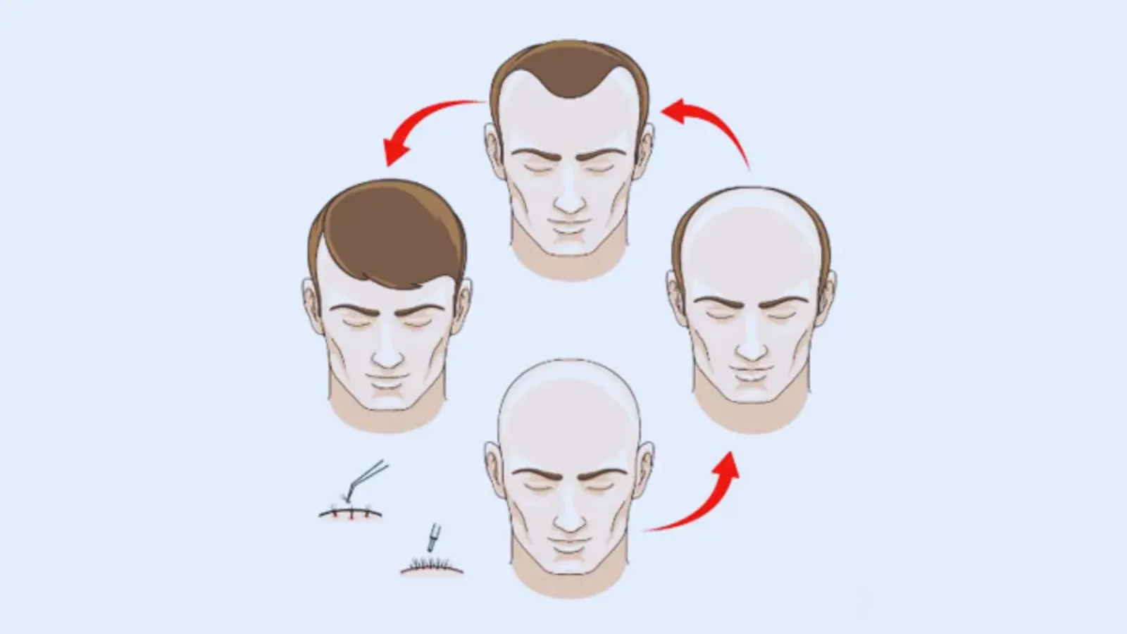 Hair Transplant Surgery in Chennai Your Ultimate Guide for 2025