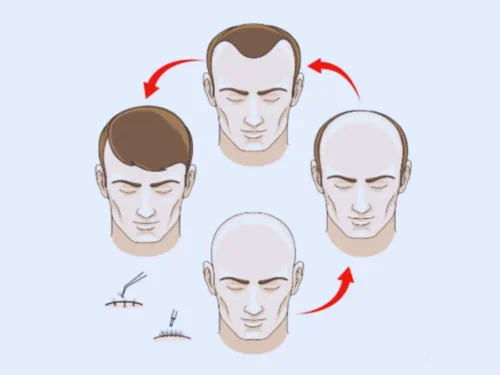 Hair Transplant Surgery in Chennai: Your Ultimate Guide for 2025