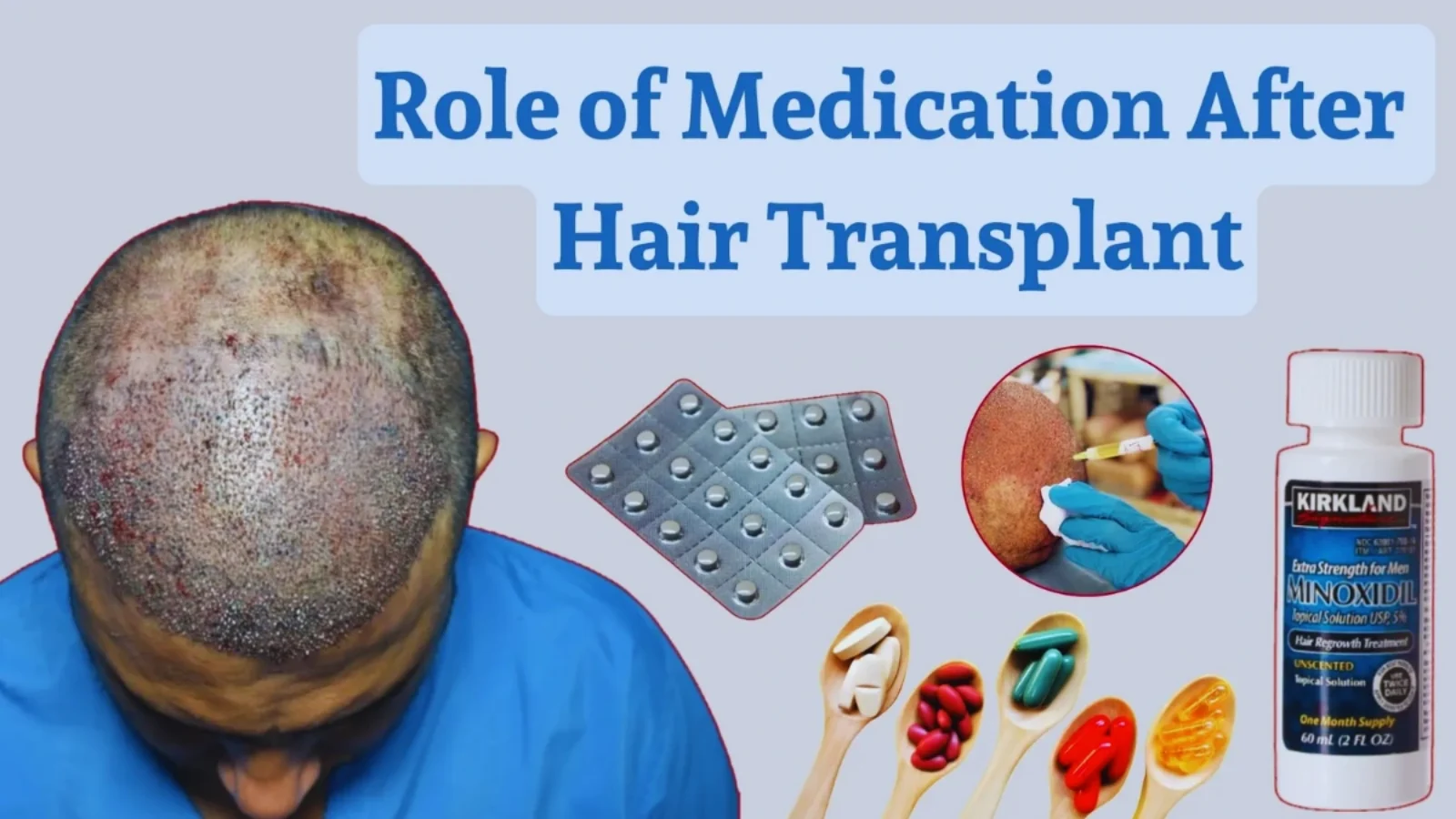 Medicine After Hair Transplant Essential Post-Operative Care for Optimal Results