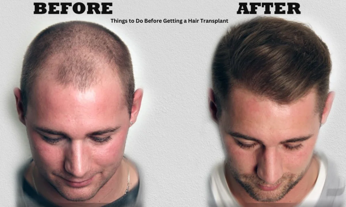 Things to Do Before Getting a Hair Transplant