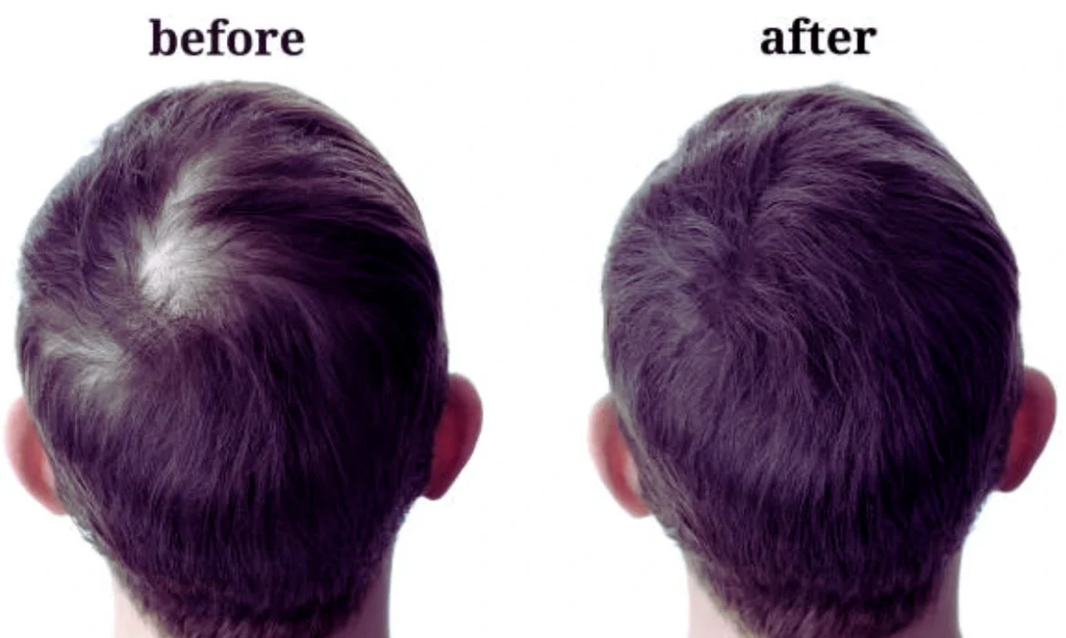 Hair Fall Treatment in India